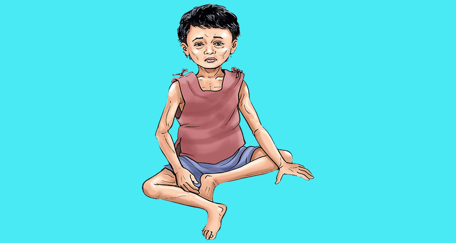 अठार हजार बालबालिकामा शीघ्र कडा कुपोषण