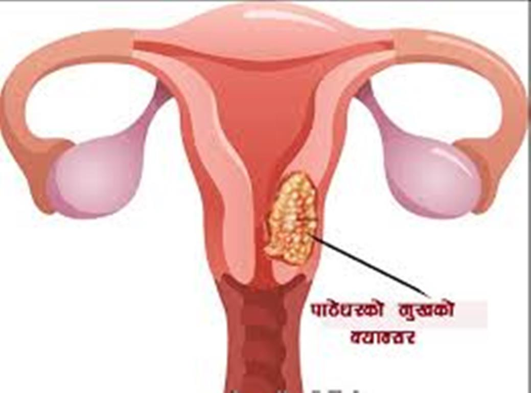 मधेशमा पाठेघरको मुखको क्यान्सर परीक्षणमा बेवास्ता